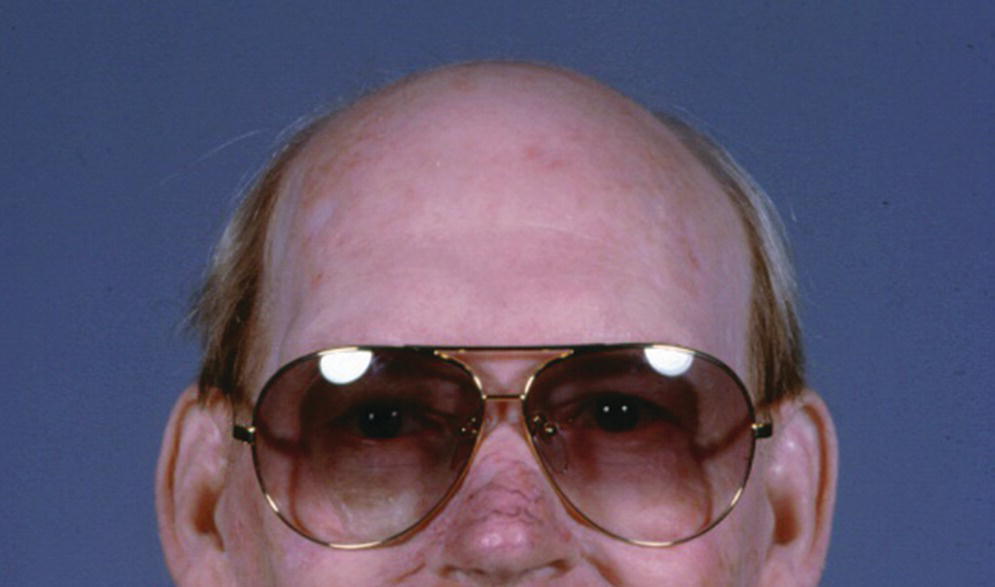 Photo of a man using eyeglasses to disguise the margins of the prosthesis.