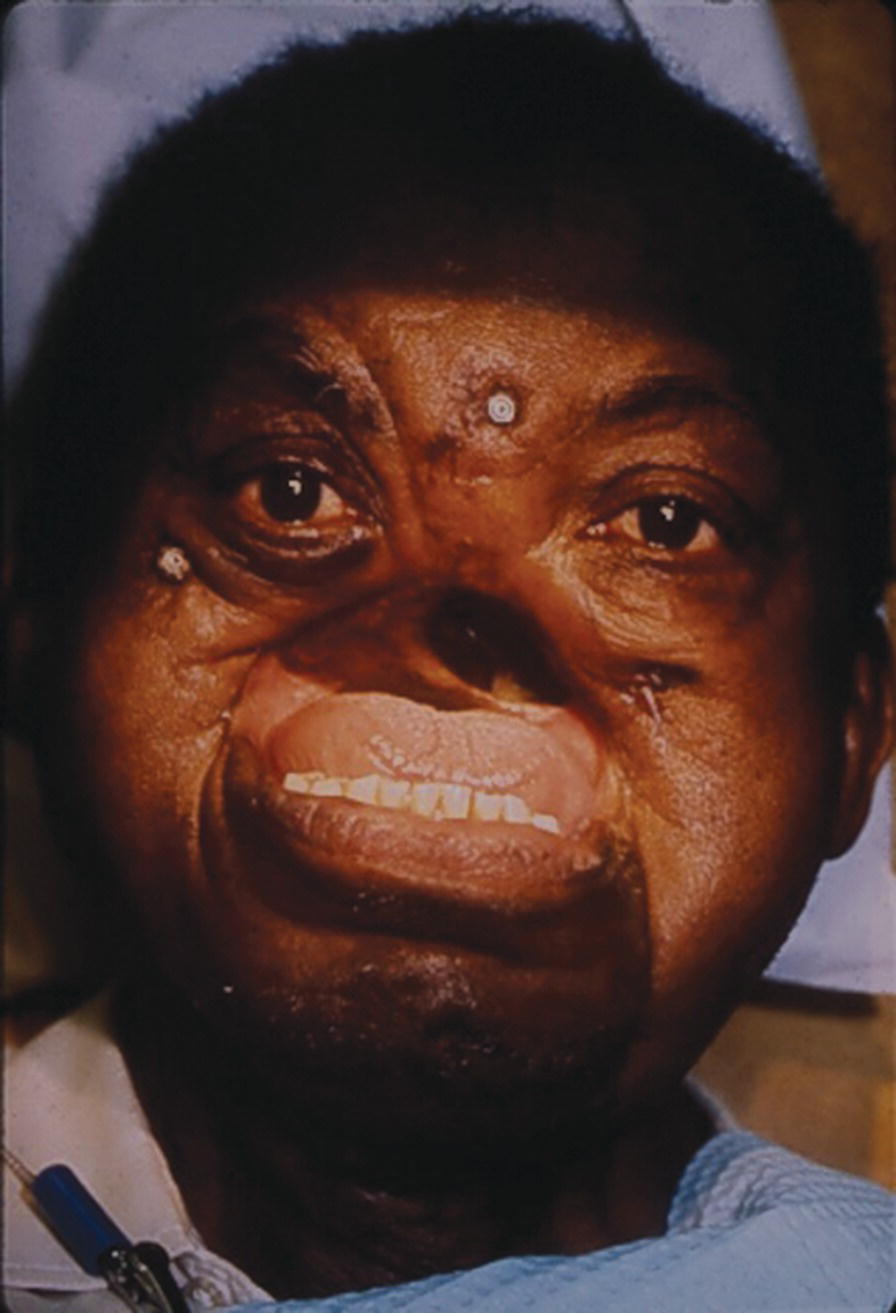 Photo of a man with missing nose and upper jaw. Two implants are placed in the zygoma and one in the frontal bone.