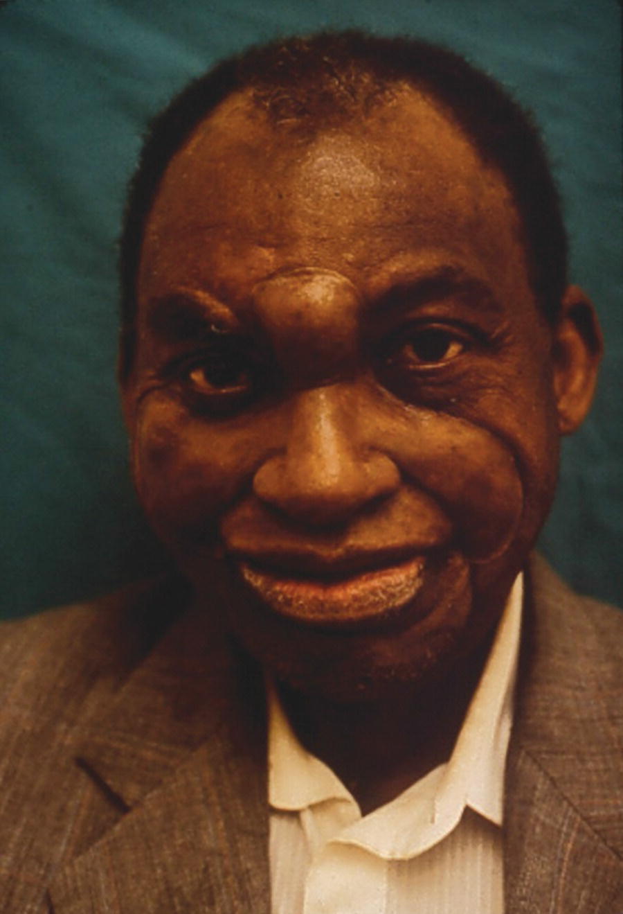 Photo of a man wearing full facial prosthesis.