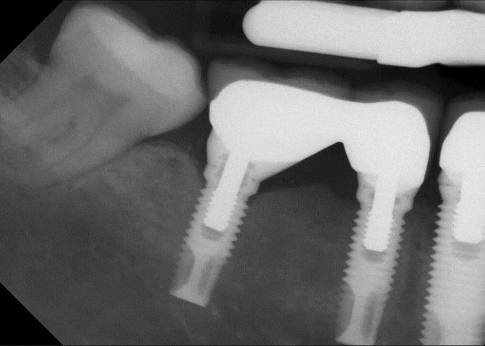 Radiograph of peri‐implant mucositis on the bottom right of first molar.
