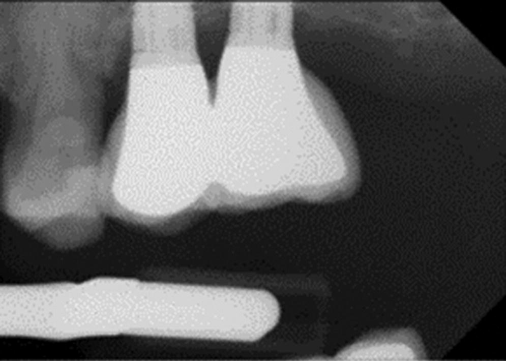 Radiograph of slight abutment misfit on anterior implant with mucositis.