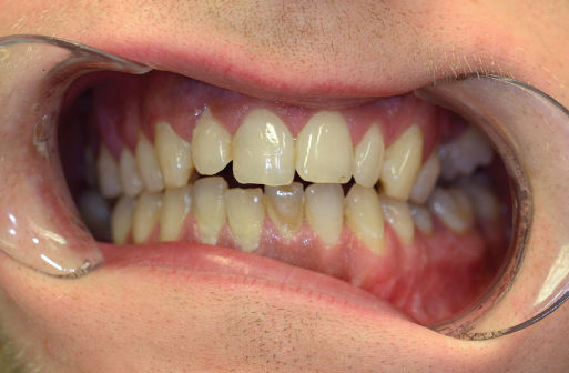 Photo showing  Frontal view of occlusion on hard biting. Loss of anterior contacts.