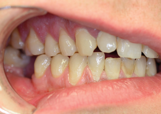 Photo showing Right side view of occlusion on hard biting. Loss of anterior contacts, only contact between 17 and 47.