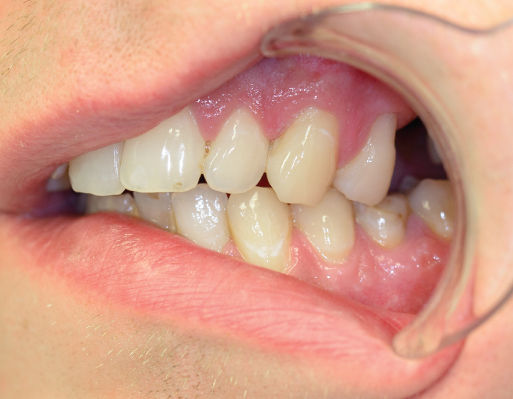 Photo showing Left side view of occlusion on hard biting. Loss of anterior contacts, only contact between 24-34 and 27-37.
