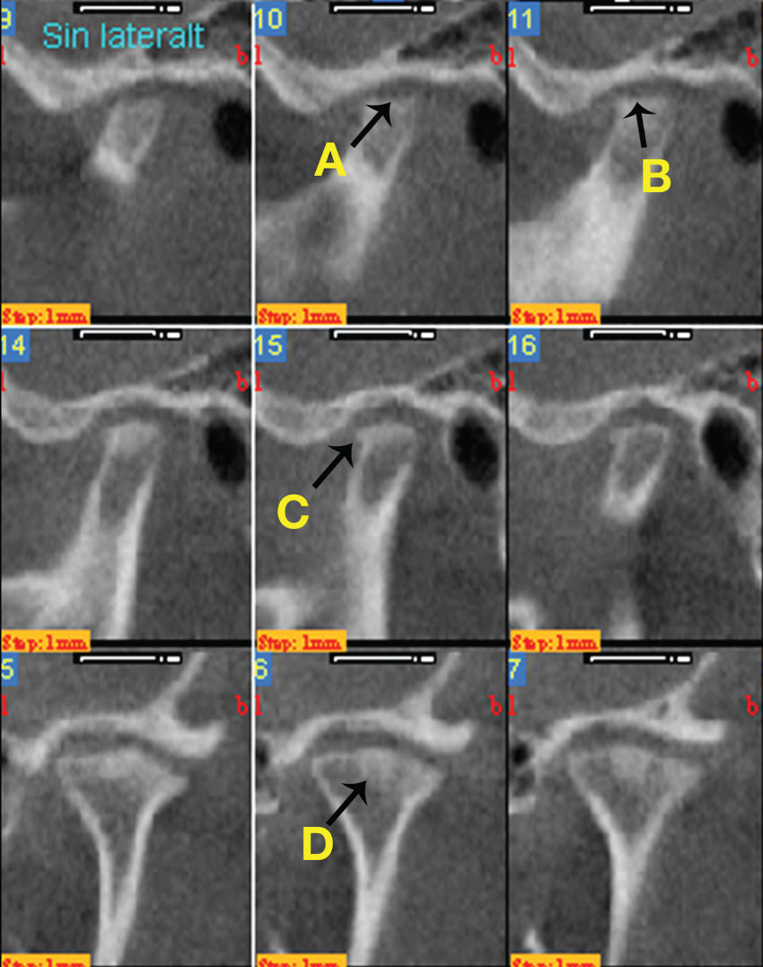 Illustration of CBCT of both TMJs showing substantial structural changes in both TMJs with signs of condylar erosions and loss of compact bone on both condyles and bilateral condyle bone loss (A), condylar and temporal flattening (B), bilateral osteophytes (C), and sclerosis (D).