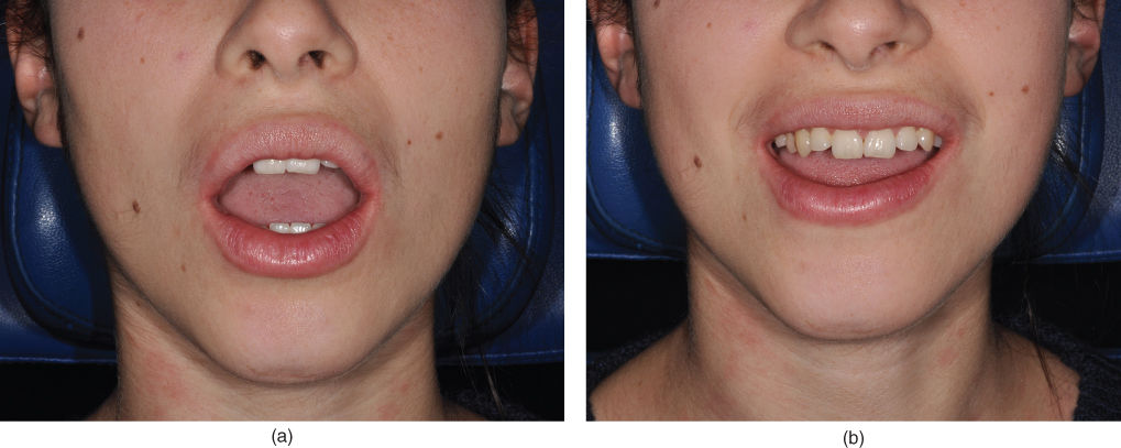 Photo showing Mandibular movement capacity: maximum mouth opening capacity.