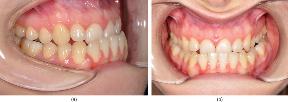 Photo showing Mandibular movement capacity: reduced laterotrusive capacity to the right.