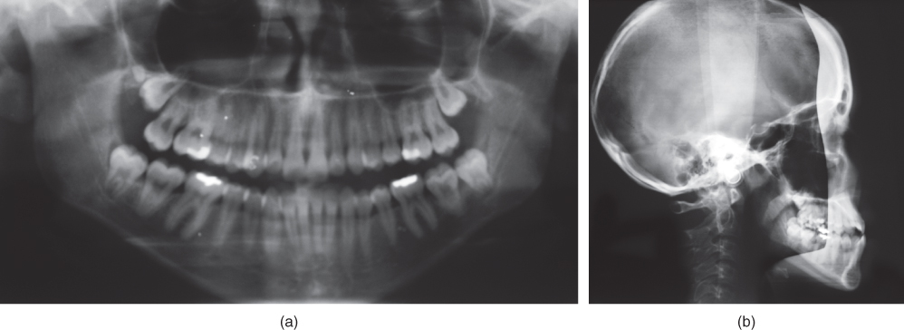 Photo showing Mandibular movement capacity: reduced laterotrusive capacity to the left.