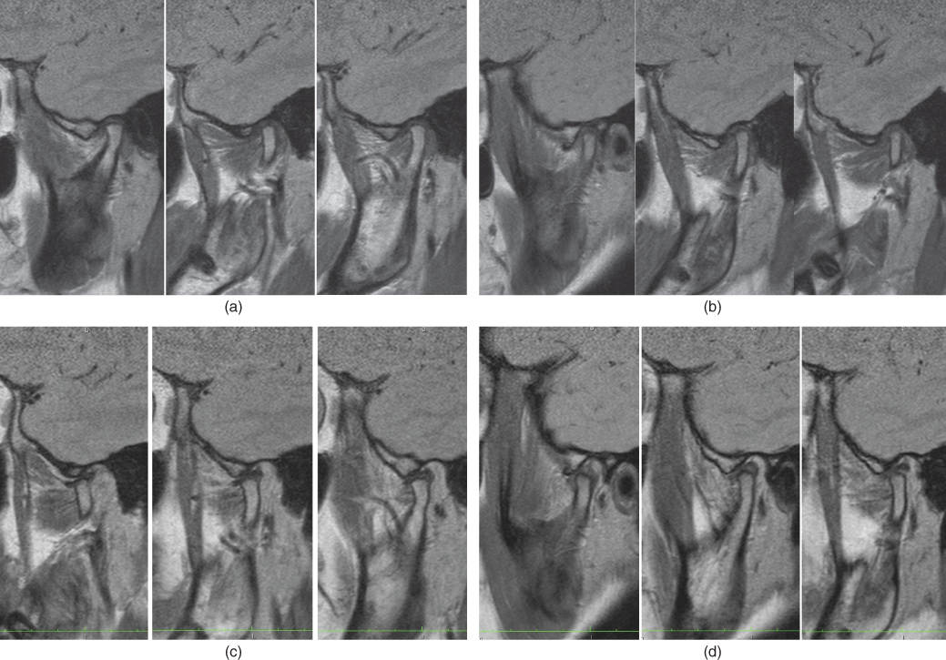 Photo showing Angle class III and anterior crossbite: Lateral view.