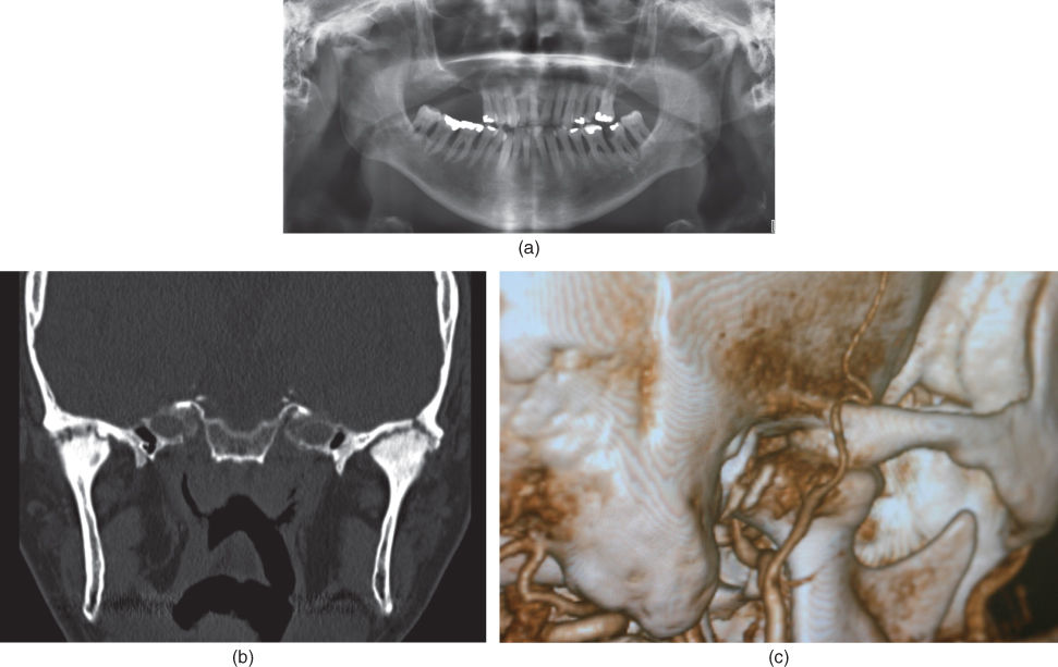 Illustration of lateral radiograph of jaws.