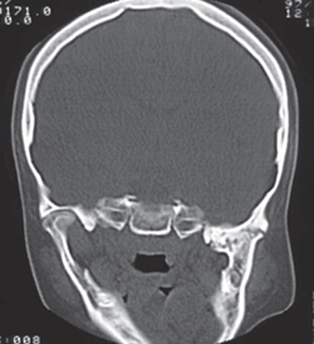 Photo showing Intraoral picture of a man with ankylosing spondylitis with occlusion on only both sides premolars. 