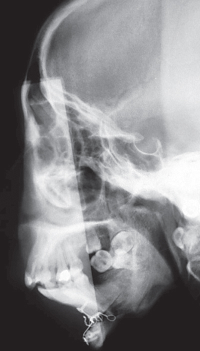 Photo showing Maximal range of motion increases the inter-incisal distance.