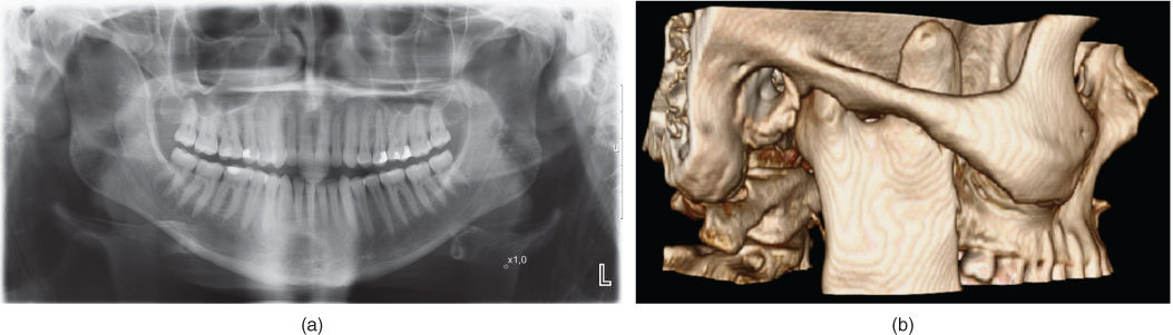 Illustration of CT with intravenous angiography of right-side TMJ with the maxillary and superficial temporal arteries in close relation to the TMJ.