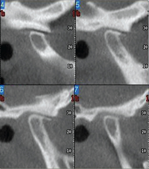 Photo showing after right TMJ ankylosis resection and placement of dermis-fat graft in the TMJ space.