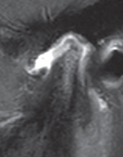 Illustration of  Panoramic radiography illustrates dental and periodontal status and indicates pathology of right coronoid process.