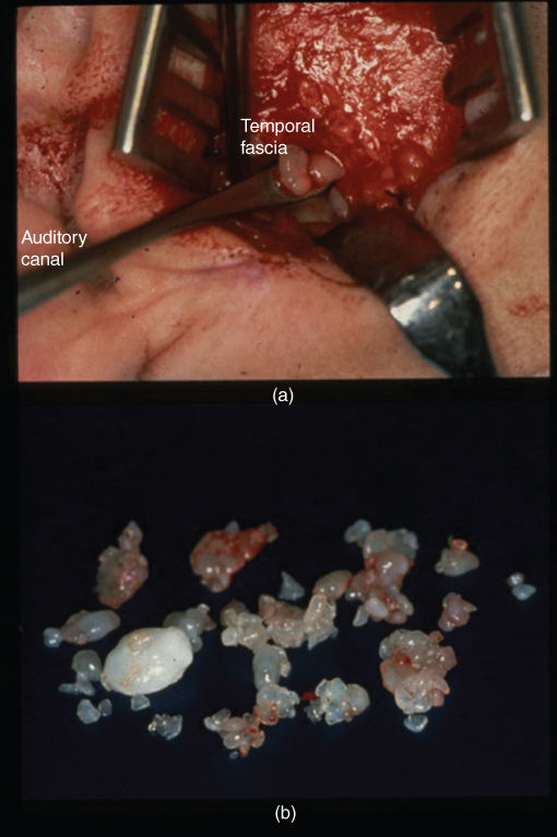 Photo showing Anterior open bite development.