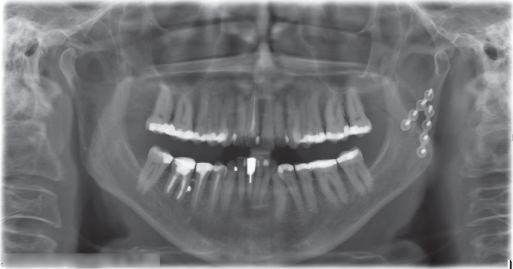 Illustration of large osteochondroma.