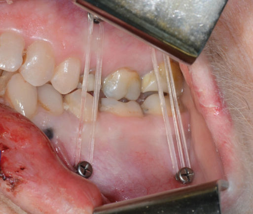 Illustration of Panoramic radiograph showing abnormal patters over the right TMJ, zygomatic arch, and mandibular ramus.