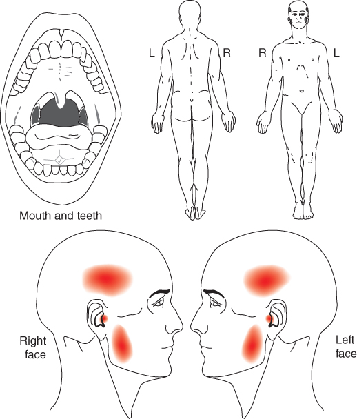 Depiction of Pain drawing by patient.