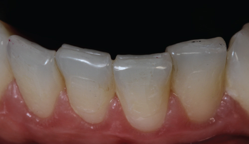 Image of Wear facets on lower incisors.