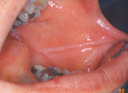 Image of Indendation in the buccal mucosa.
