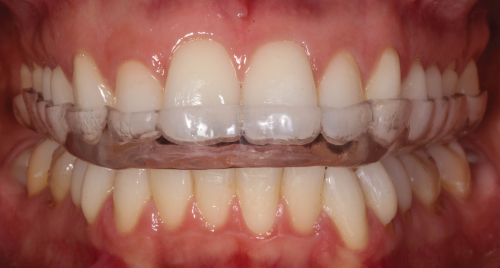 Image of Occlusal stabilization appliance.