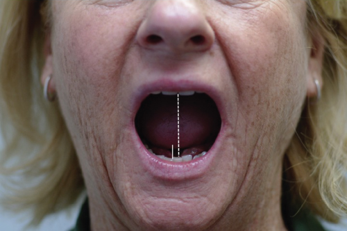 Facial photo of Mouth slightly open, displaying alignment of dental midlines (white solid line).