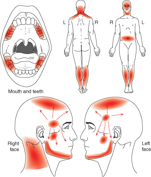 Pain drawing showing Presence of frequent cervicalgia, abdominal and leg pain.