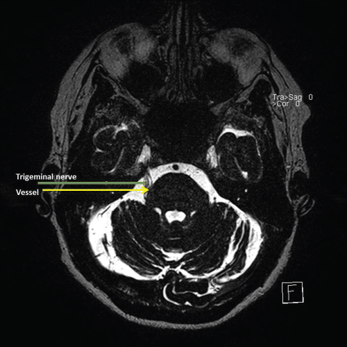 Illustration of MRI showing trigeminal nerve in contact with a vessel.