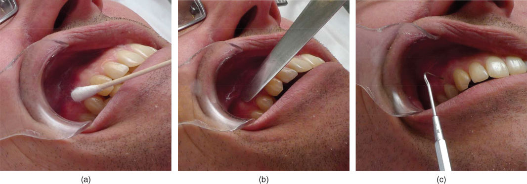 Anatomical drawing showing pain locations (shaded areas): dentoalveolar pain.