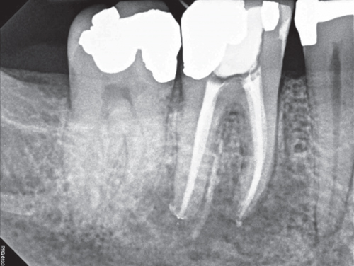 Illustration of Preoperative radiograph of teeth 24-26.