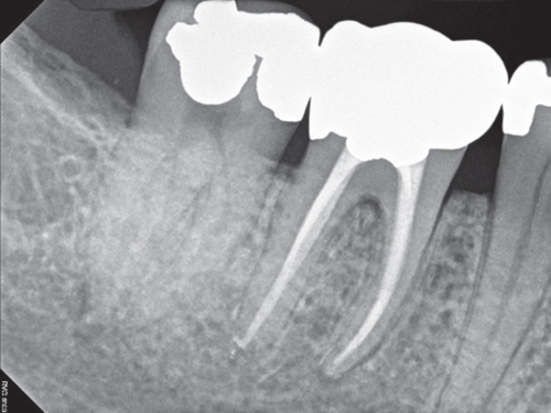 Photo showing Extirpated tooth pulp.
