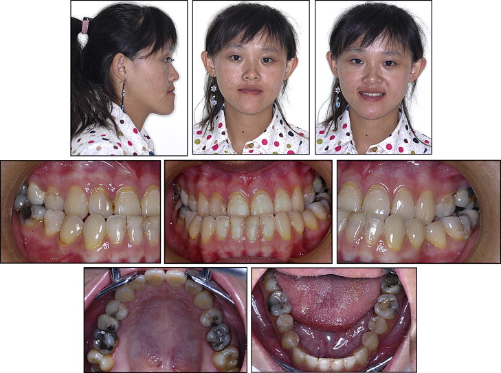 class 3 malocclusion