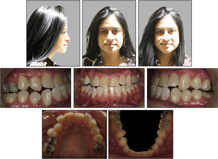 camouflage-treatment-of-skeletal-class-iii-malocclusion-with