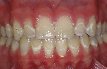 white spots on gums