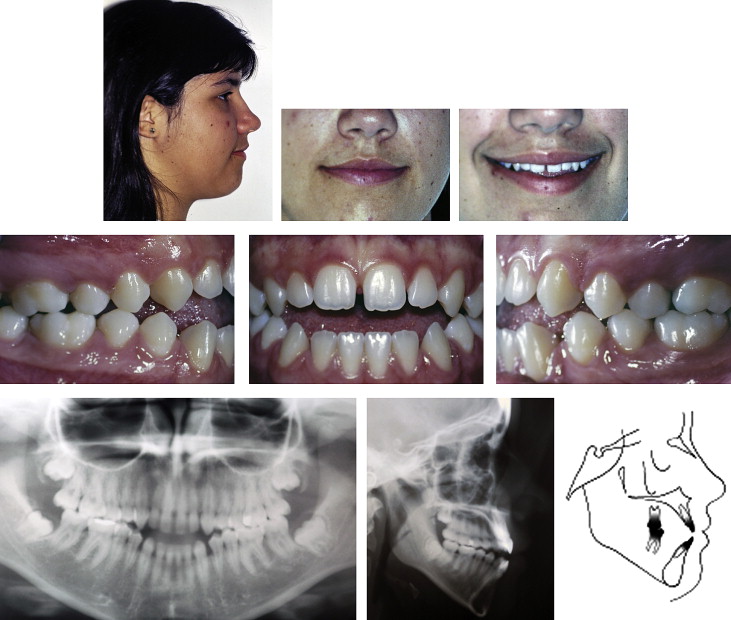 Multiloop edgewise archwire in the treatment of a patient with an anterior  open bite and a long face