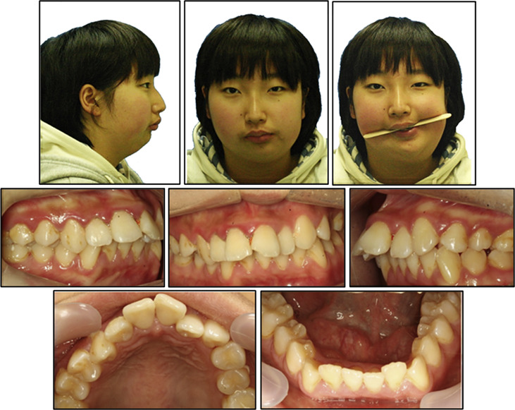 Transport distraction osteogenesis combined with orthodontic