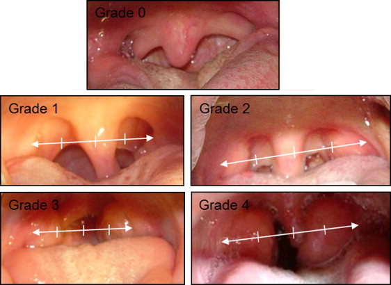 Influence Of Tonsillar Grade On The Dental Arch Measurements Pocket 