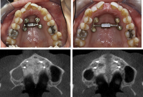 What are the limits of microimplant-assisted palatal expanders