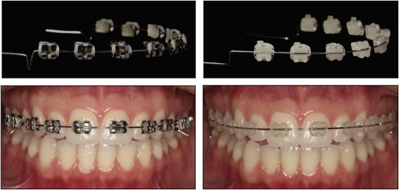 Types of Braces (Fixed Appliances)