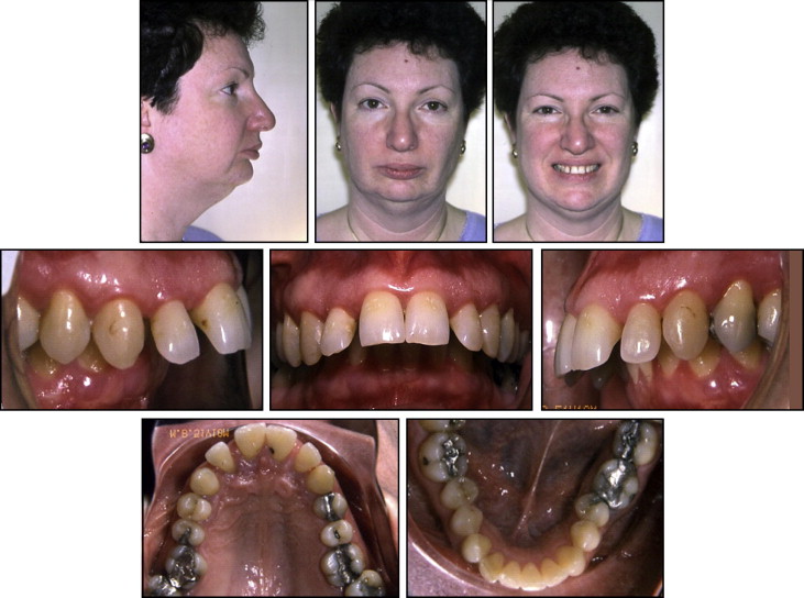 Vu Orthodontics - Class II (overbite)