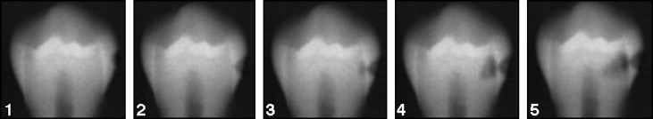 Attachments Bonding and Interproximal Reduction