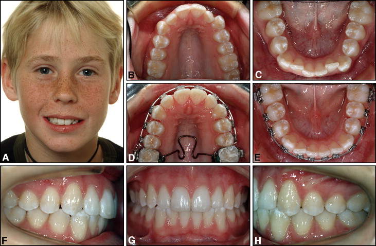 Attachments Bonding and Interproximal Reduction