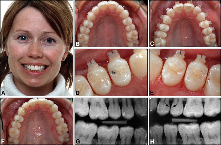 Attachments Bonding and Interproximal Reduction