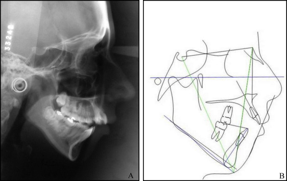 Camouflage Of A High-angle Skeletal Class II Open-bite Malocclusion In ...