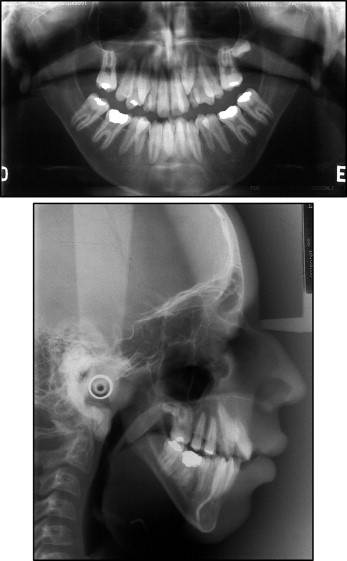 orthodontic-treatment-of-a-patient-with-lowe-syndrome-pocket-dentistry