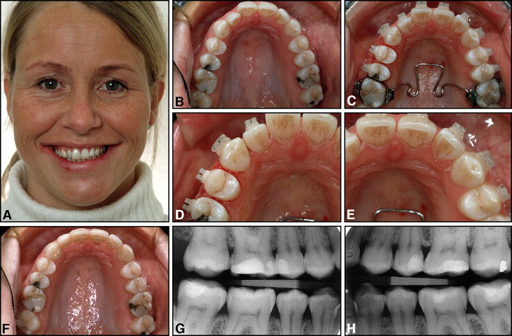 Attachments Bonding and Interproximal Reduction