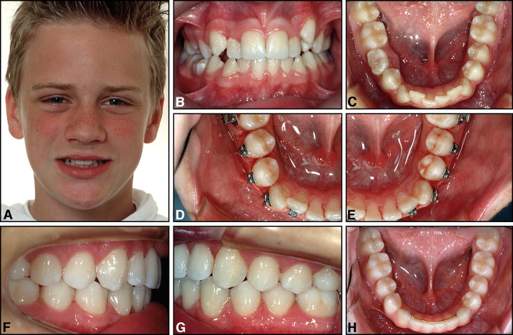 Attachments Bonding and Interproximal Reduction