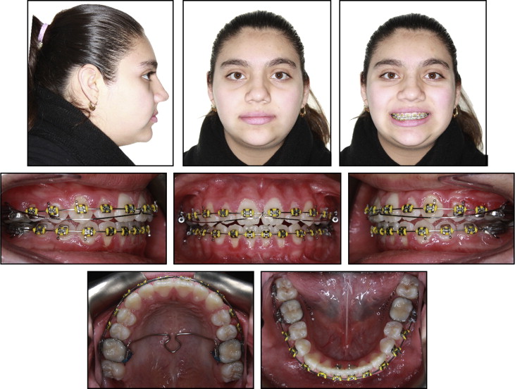 Nonsurgical Approach To Class I Open-bite Malocclusion With Extrusion ...