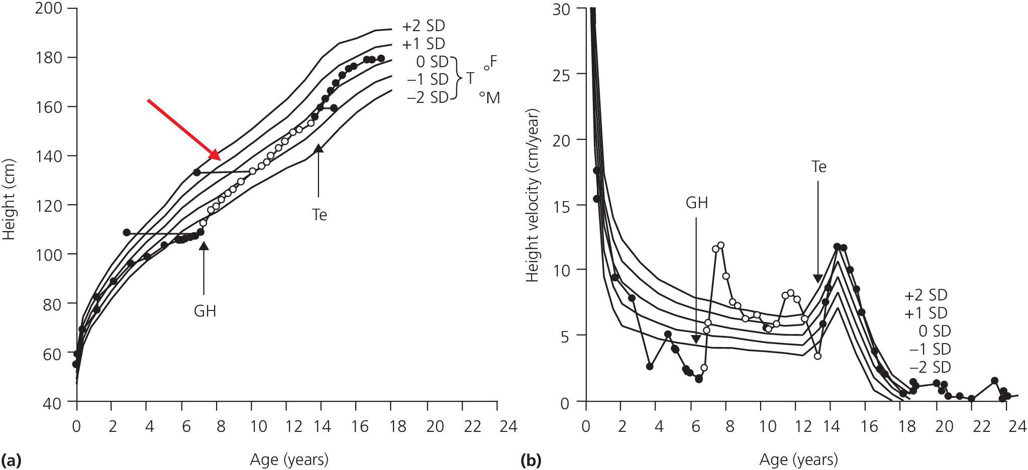 2 Graphs of normal height displaying 5 curves based on healthy children (a) and Tanner’s longitudinal study of healthy children (b) with ±1 and ± 2 standard deviations.